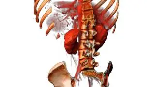 3D View Of Horseshoe Kidney