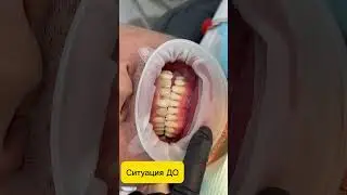 Восстановили улыбку 😍😍😍 #dentist #smiledesigndental #smile #топ #смех #доктор