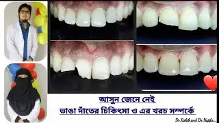 ভাঙা দাঁতের চিকিৎসা ও খরচ || Broken tooth Treatment 