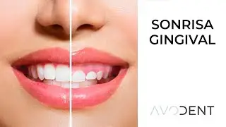 ¿Qué es la sonrisa gingival? ¿Cómo corregirla? | Clínica dental Avodent en Alcobendas