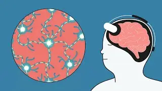 What is tDCS