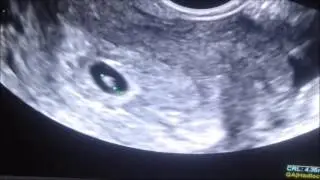 First Ultrasound - Baby has a Heartbeat!