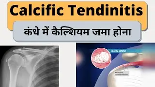 Calcific Tendinitis of Shoulder | Symptoms and Treatment कांधे में कैल्शियम जमा होना
