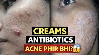 Dermtologist, Creams, Antibiotics -Acne Phir Bhi Kyun Wapas Aate Hai?