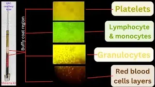 QBC capillary tube after micro centrifuged | @medicallabtechnologysajal6903