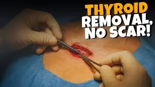 Thyroid Gland Removal Surgery | Thyroidectomy