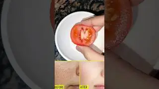🔥open pores home remedy #openpores #skincare #skincaretips #ytshorts #viralshorts #viral #shorts