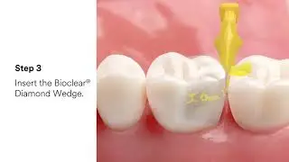3M&trade; Filtek&trade; Dental Restoratives and Bioclear&reg;