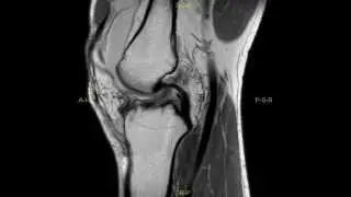 Lateral tibial plateau fracture - complete MRI examination