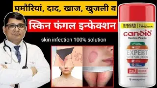 CANDID DUSTING POWDER REVIEW IN HINDI | दाद, खाज, स्किन फंगल इन्फेक्शन में उपयोगी |