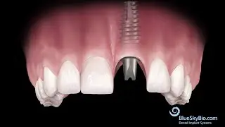 Multi Purpose Abutment Instructional Video