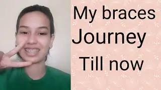 My braces journey//q n a related to braces//all about braces