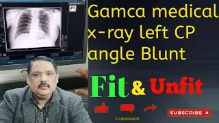 CP Angle Blunt X-ray Explained | GAMCA Medical Test Guidelines