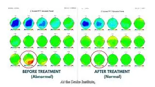 Treating ADHD Without Medication at the Drake Institute