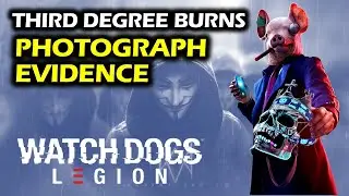 Third Degree Burns: Photograph Evidence | Side Quest | Furzton Tower Block | Watch Dogs Legion