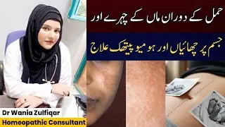 Pregnancy Melasma & Spots Treatment | Safe Homeopathic Remedies for Moms | Dr Wania Zulfiqar |