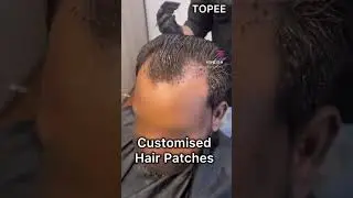 Front hair patch for receding hairline| Custom hair systems in Bangalore| Baldness solution for men