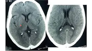 Basics of brain CT scan part II