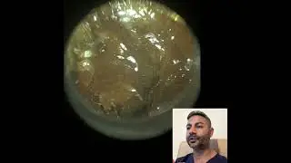 436 - 100% удаление закупоренной ушной серы с помощью новых ушных зеркал WAXscope&reg;