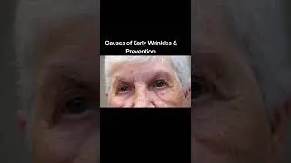Early Wrinkle Prevention #healthliving #wrinkles #wrinklesfree #wrinkleremover #skincare #skin