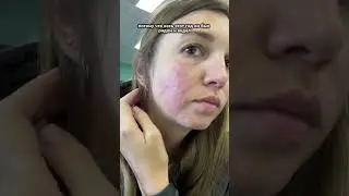 Стероидный дерматит #дерматит #заболевание #кожалица #дерматология