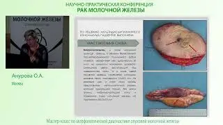 Постлучевая ангиосаркома молочной железы
