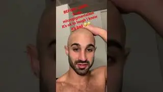Before & After Scalp Micropigmentation (SMP)