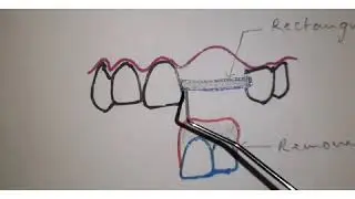 Andrew's Bridge in Fixed Prosthodontics