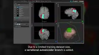 Research at NVIDIA: 3D MRI Brain Tumor Segmentation Using Autoencoder Regularization