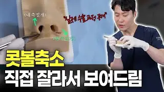 (직접 시연) 콧볼 축소 수술 원리 완벽 정리