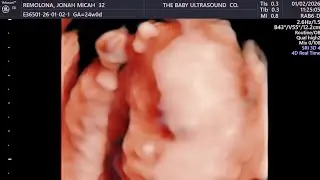 4D Ultrasound Baby Lablab Experience | Seeing Our Baby’s Face for the First Time