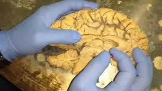 Mid Sagittal Section of the Brain