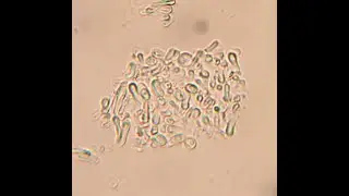 Fungal Lung Cryotherapy Treatment Short video