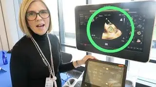 3D Echocardiogram of the Aortic Valve