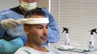Hair-by-Hair&reg; Restoration: Edgar&rsquo;s FUE Success Story