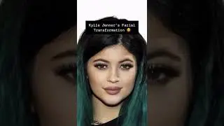 Kylie Jenner&rsquo;s Facial Transformation