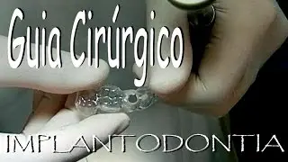 Confecção de Guia Cirúrgio Plastificado UFPE HD