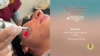 Can Laser Treatments Remove Acne Scars? Pico vs. CO2 Explained