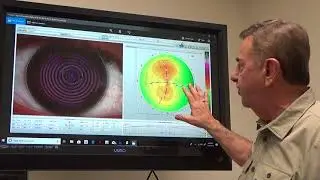 How the Vision Shaping Treatment Lenses are Designed