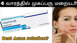 Adapalene gel review in tamil l Best acne treatment explained #acne #blackheads #oilyskin #clearskin