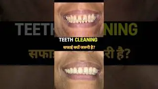Teeth Cleaning & Scaling 🦷 | दाँतों की सफाई | Pyorrhea Treatment  by Dr Neetu Agarwal