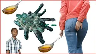 Burya amibe itera indwara ya hemorrhoids. Dore ibimenyetso, n'imiti yayo.