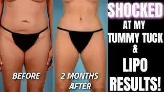 SHOCKED at my Tummy Tuck and Lipo Results
