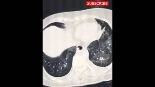 Medication induced pulmonary injury - HRCT Chest - Basic Radiology