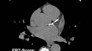 Cardiac MRI detects heart changes in older athletes