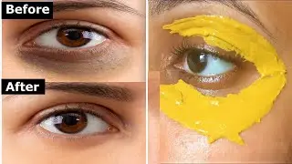 How to Get Rid of Under Eyes Bags and Under Eyes Dark Circle Permanently in 15 Days!