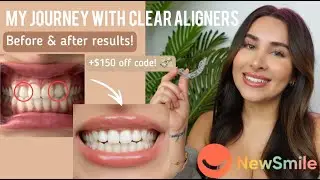 NewSmile Clear Aligners review- before & after results || is it worth it? + Huge discount code!