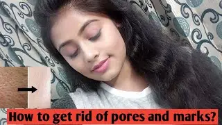 How to get rid of pores | How to get rid of marks | How to get clear skin | Nature sure