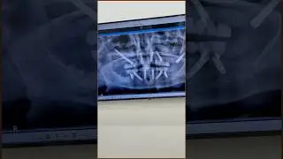 Same-day teeth for complex cases &mdash; zygomatic, pterygoid & All-on-X implants. Restore function fast.