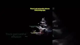 #echocardiography #echo #heartmonitoring #heartmonitoring #ytshorts #PE@SafaMedicalLecture